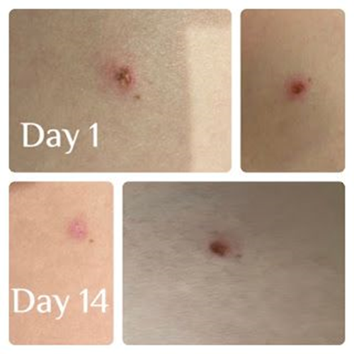 Ways to Remove Skin Tags at Home and Salon